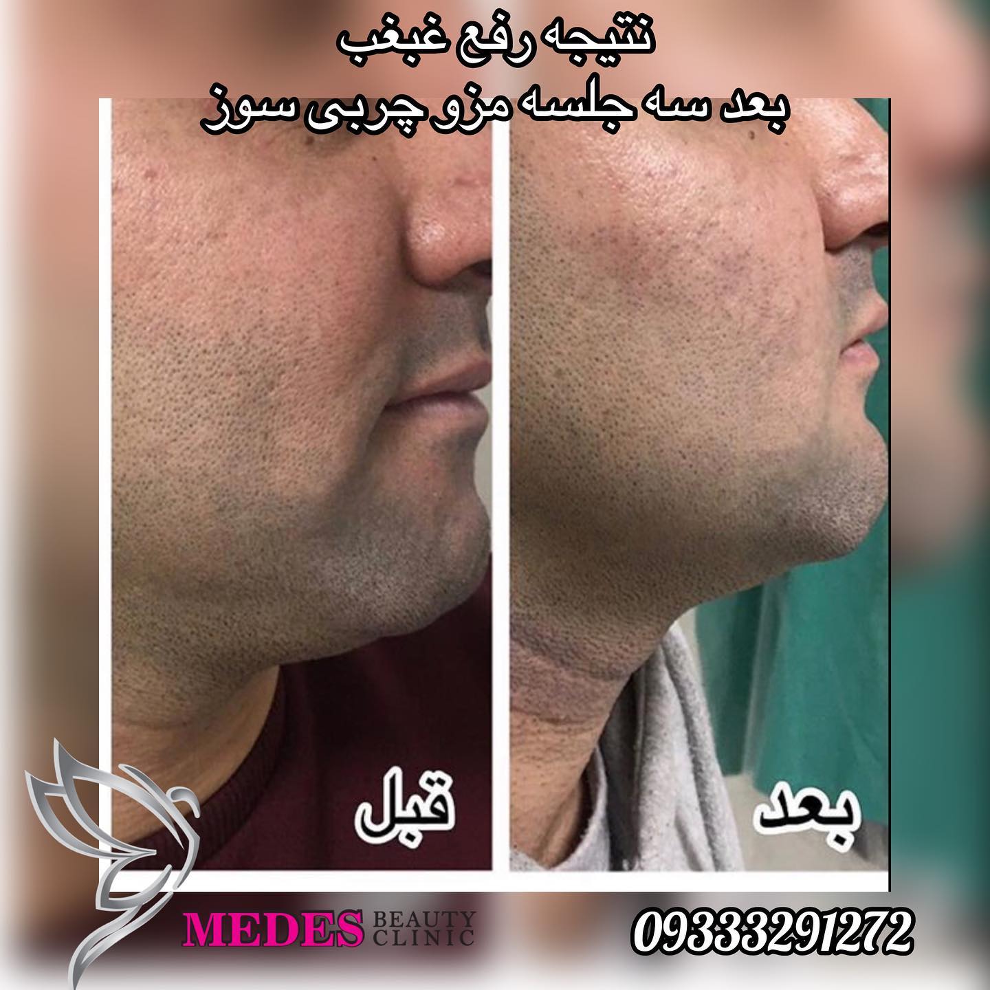 گالری مزوتراپی